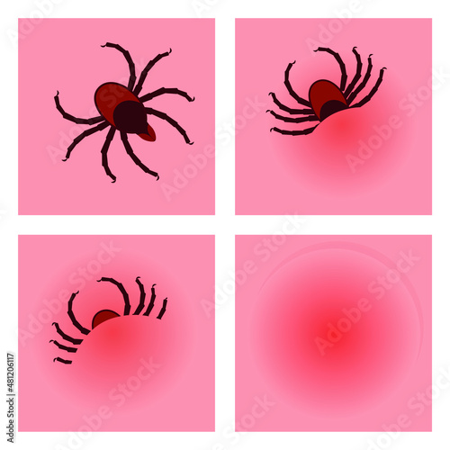 The tick penetrates the skin. A set of illustrations with a blood-sucking insect. Vector, color cartoon flat design, eps 10.