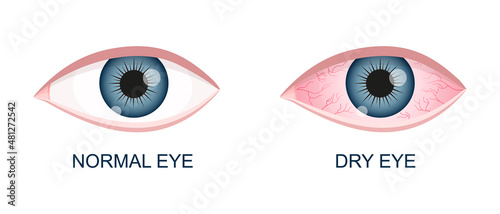 Human eye healthy and dry. Normal and inflamed bloodshot eyeball with irritation and red conjunctiva. Symptoms of keratitis, allergy, conjunctivitis, uveitis. Vector cartoon illustration. photo