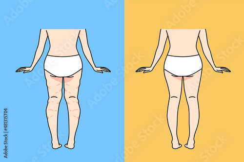 Back view of woman in underwear before and after cellulite removal. Female lower body legs and ass have anti-cellulite procedure or treatment. Body shape and healthcare. Vector illustration. 