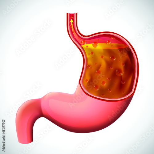 An illustration of a gastric reflux, dissected to show the inside, for medical and educational use.