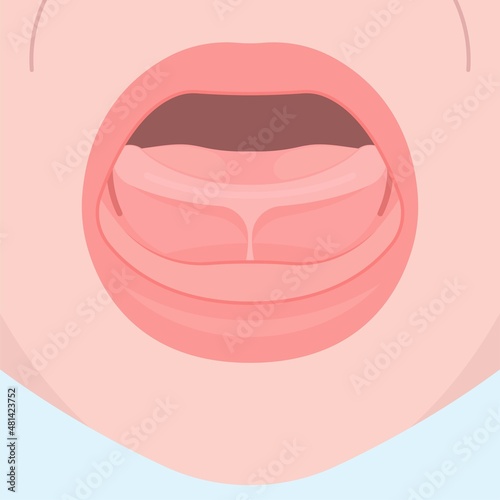Tongue tie top lip bottle feeding sore damaged nipples issue care nurse Breast oral colic milk supply dentistry Torn frenuloplastika thrust frenulotomy frenulectomy nursery abnormal removal baby