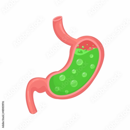 Vector medical illustration of stomach inside. Sick stomach. Gastritis and acid reflux, indigestion, vomiting, heartburn and stomach pain problems.
