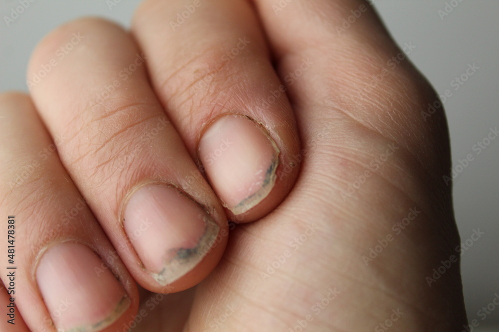 damaged damaged nail without manicure with dirt close-up. Nail Health Care Stock Photo | Adobe Stock damaged damaged nail without manicure with dirt close-up. Nail Health Care Stock Photo | Adobe Stock