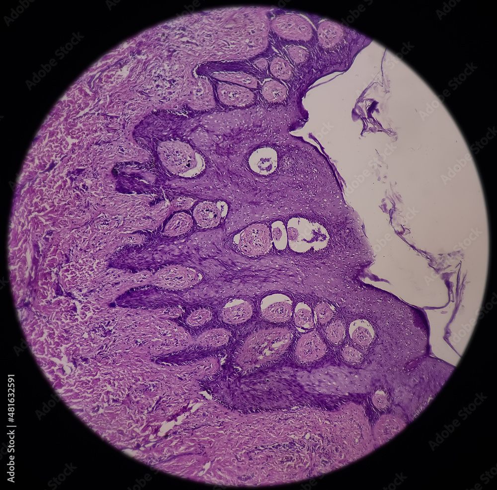 Fotka „Scar endometriosis, microscopic image show fibrocollagenous
