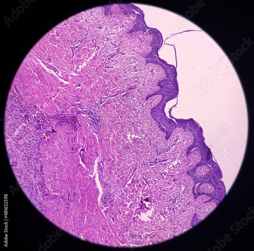 Scar endometriosis, microscopic image show fibrocollagenous tissue, ingrowth of endometrial glands and stroma, It is rare disease, 40x view. photo