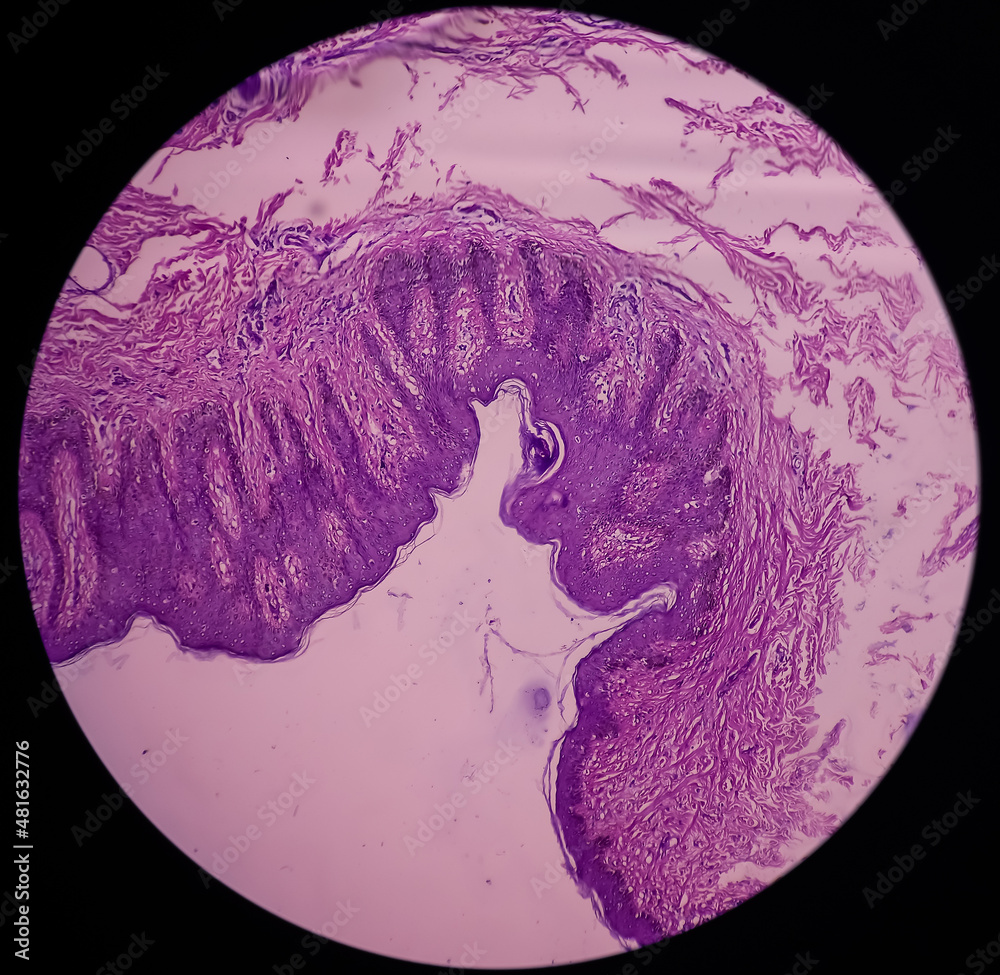 Scar endometriosis, microscopic image show fibrocollagenous tissue