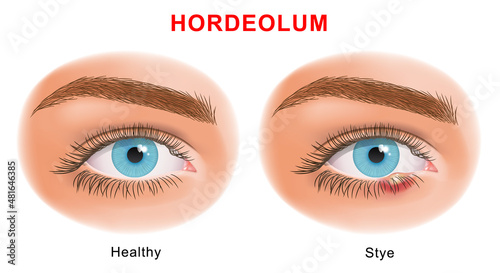 Eye Stye (Sty) problem before and after treatment. external hordeolum of lower eyelid. stye vector illustration. photo