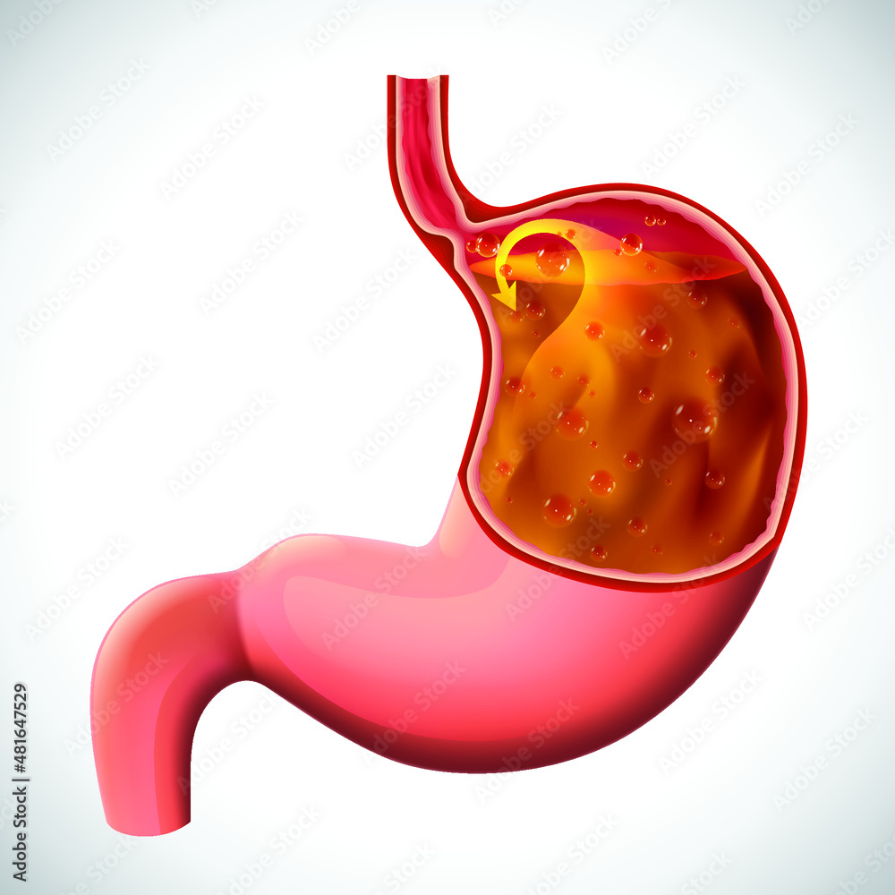 An illustration of a gastric reflux, dissected to show the inside, for ...