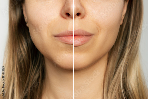 Cropped shot of young blonde woman's face with lips before and after lip enhancement on a gray background. Injection of filler in lips. Lip augmentation photo