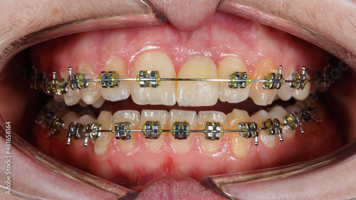braces system on top and lower jaw for smooth bite