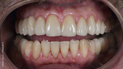 Dental photo jaws with veneers