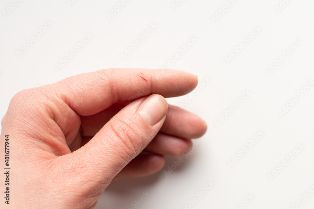 Deep cut on index finger. Woman's hand. Injured finger on a white background. Hand close up. Finger injury Deep cut on index finger. Woman's hand. Injured finger on a white background. Hand close up. Finger injury