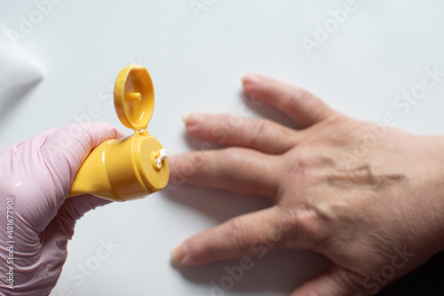 Primary examination of the patient by a traumatologist. The doctor applies an anesthetic cream to the site of the bruise. Middle finger injury. Woman's hand with an injury.Step-by-step instruction photo