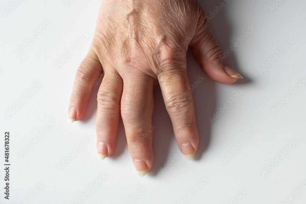 Injury of the female hand. Contusion of the middle finger of the right