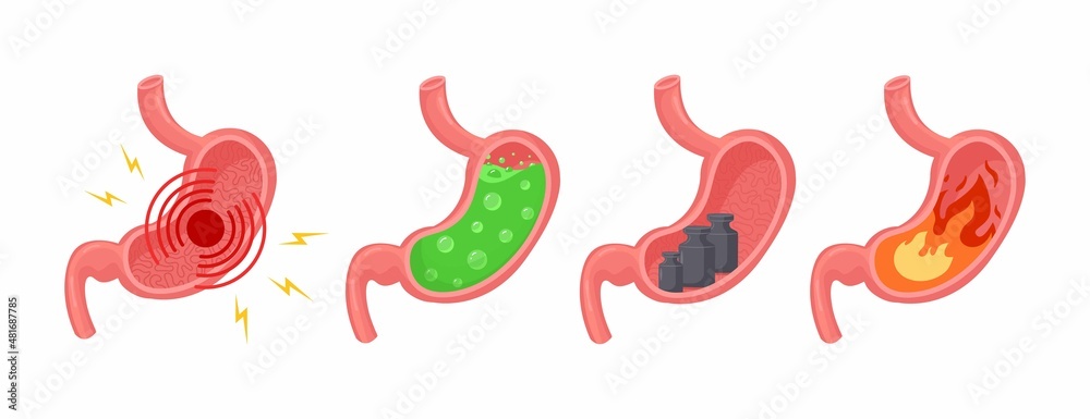 Diseases of stomach. Medical vector illustration set. Stomach pain, gastritis, indigestion, vomiting, heartburn. Pyrosis fire disorder, gastric acid reflux, Abdominal bloated ball, green liquid nausea Diseases of stomach. Medical vector illustration set. Stomach pain, gastritis, indigestion, vomiting, heartburn. Pyrosis fire disorder, gastric acid reflux, Abdominal bloated ball, green liquid nausea