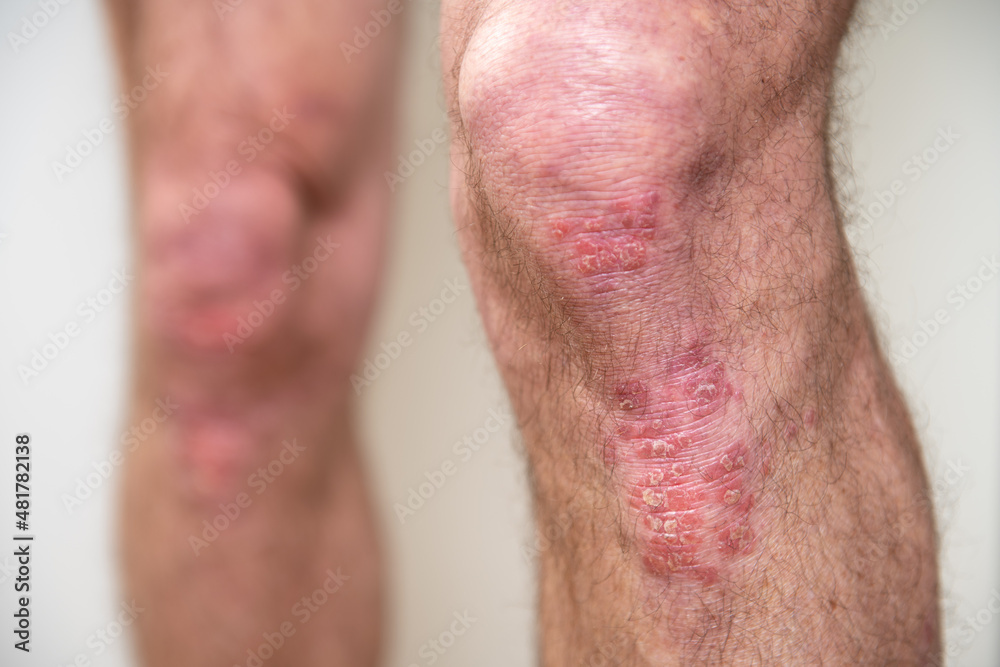 Acute psoriasis on elbows is an autoimmune incurable dermatological skin disease. Large red, inflamed, flaky rash on the knees. Joints affected by psoriatic arthritis Acute psoriasis on elbows is an autoimmune incurable dermatological skin disease. Large red, inflamed, flaky rash on the knees. Joints affected by psoriatic arthritis
