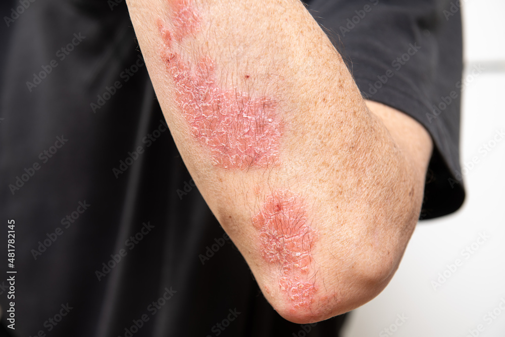 Acute psoriasis on elbows, knee is an autoimmune incurable dermatological skin disease. Large red, inflamed, flaky rash on the knees. Joints affected by psoriatic arthritis - obrazy, fototapety, plakaty 