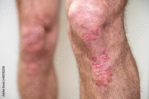 Acute psoriasis on elbows is an autoimmune incurable dermatological skin disease. Large red, inflamed, flaky rash on the knees. Joints affected by psoriatic arthritis photo