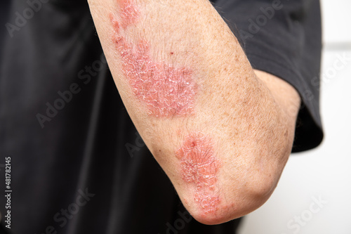 Acute psoriasis on elbows, knee is an autoimmune incurable dermatological skin disease. Large red, inflamed, flaky rash on the knees. Joints affected by psoriatic arthritis photo