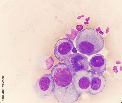 Abnormal giant cells in body fluid. photo