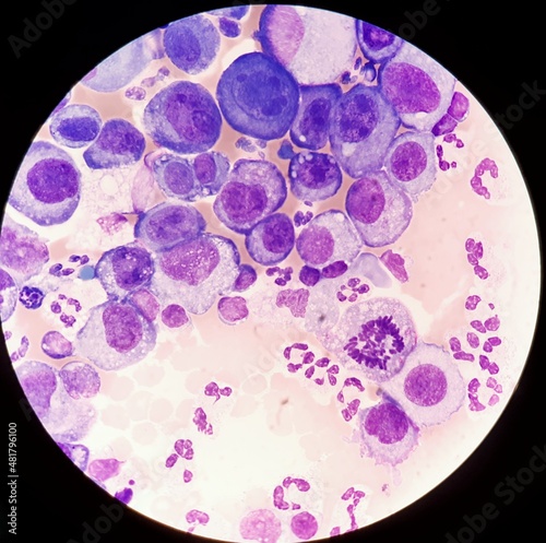 Abnormal giant cells in body fluid. photo