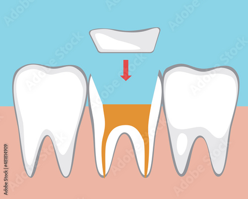 Tooth microprosthetics, Flat vector stock illustration with Canal treatment, molar depulpation and Ceramic orthodontic inlay