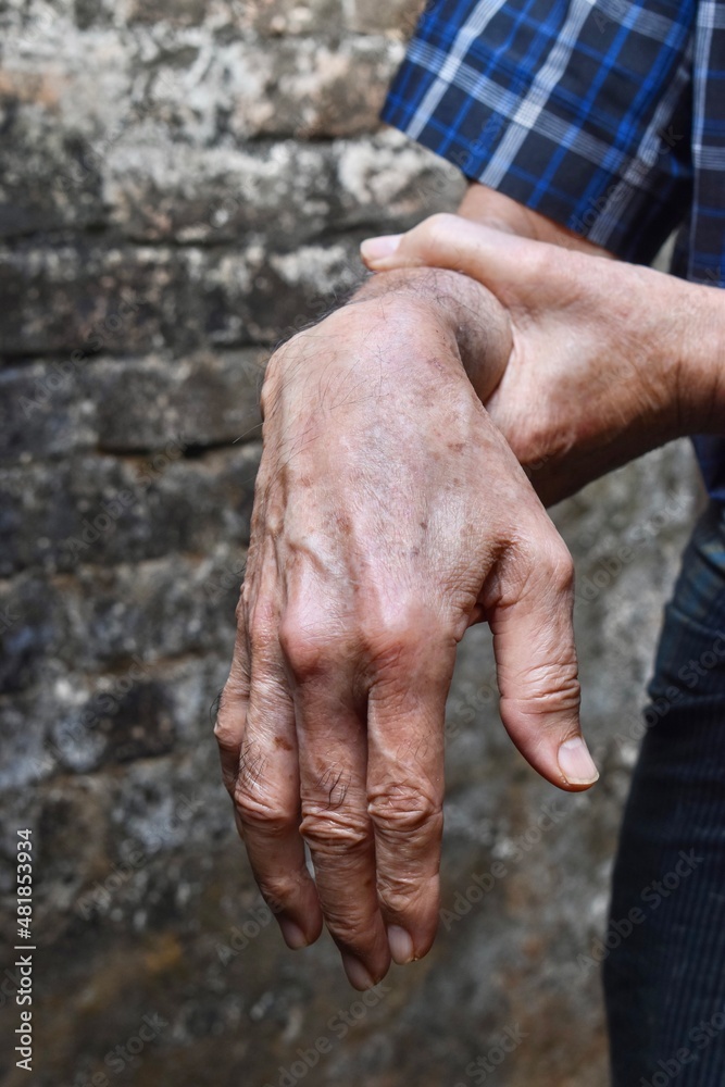 Fototapeta premium Radial nerve injury or wrist drop