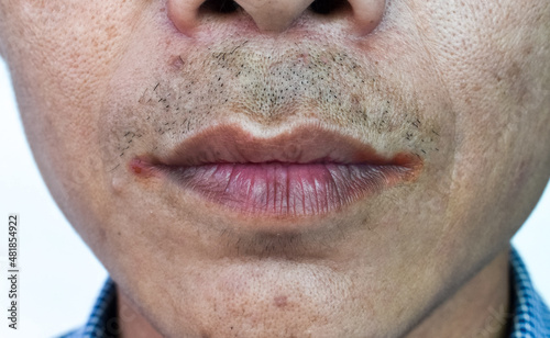 Angular stomatitis or angular cheilitis or perleche in asian alcoholic man. Cracked lips. photo