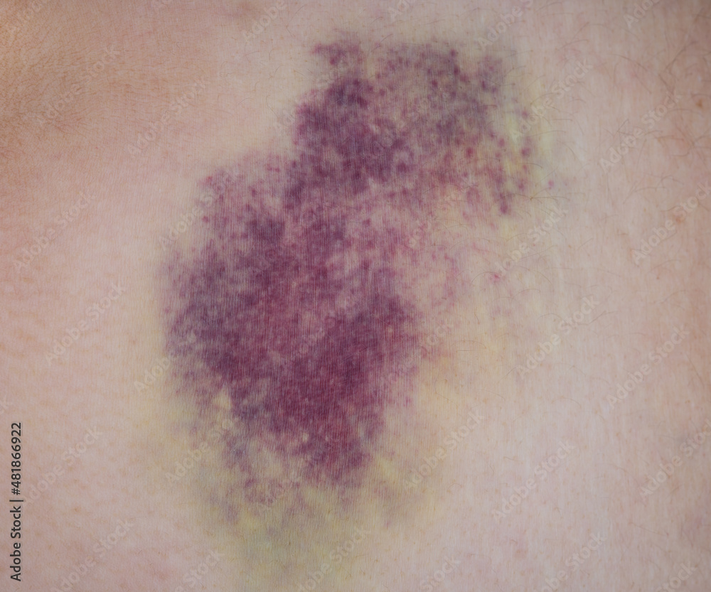 Fototapeta premium A large bruise on a person body