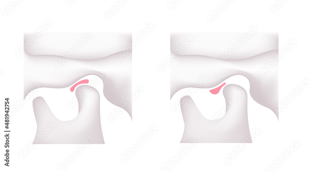 Illustration comparing the shapes of the articular disk ( normal jaw and Temporomandibular disorders ) Illustration comparing the shapes of the articular disk ( normal jaw and Temporomandibular disorders )