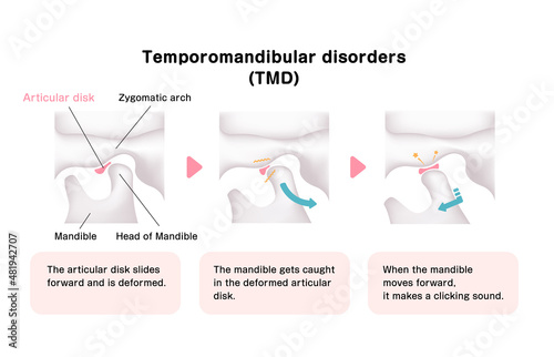 Illustration of the cause of temporomandibular disorders (TMD) photo