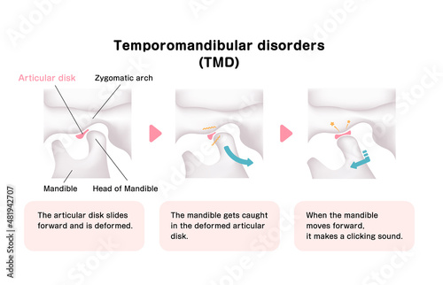 Illustration of the cause of temporomandibular disorders (TMD)