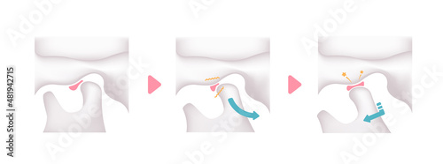 Illustration of the cause of temporomandibular disorders (TMD)