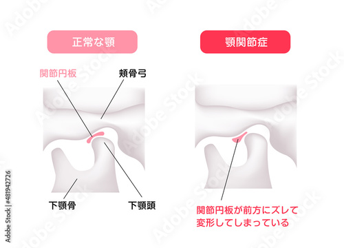 正常な顎（あご）と顎関節症の顎 / 間接円板の違い ベクターイラスト
