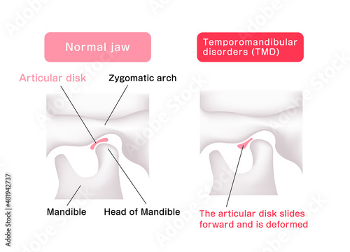 Illustration comparing the shapes of the articular disk ( normal jaw and Temporomandibular disorders )