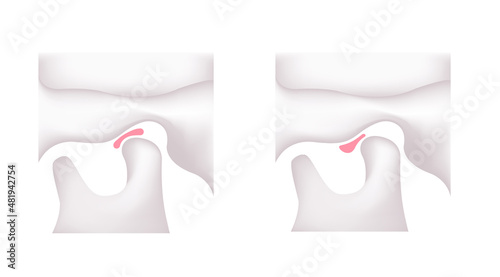 Illustration comparing the shapes of the articular disk ( normal jaw and Temporomandibular disorders )