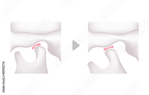 Structural illustration when opening and closing the jaw (no text )