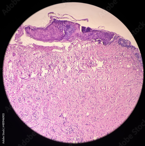 Oral mucosa carcinoma: Squamous cell carcinoma, poorly differentiated, show fibrocollagenous tissue, malignant neoplasm, atypical squamous epithelial cells. photo