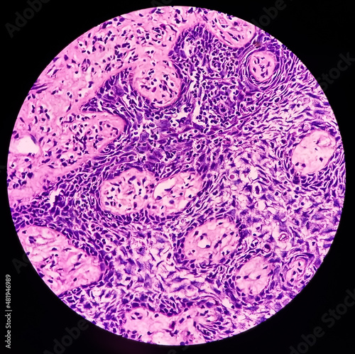 Oral mucosa carcinoma: Squamous cell carcinoma, poorly differentiated, show fibrocollagenous tissue, malignant neoplasm, atypical squamous epithelial cells. photo