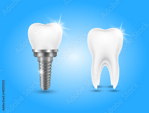 Tooth and teeth implant for stomatology set. Implant structure models. Screw denture orthodontic implantation. stomatology clinic concept. Realistic isolated 3D vector ​illustration.