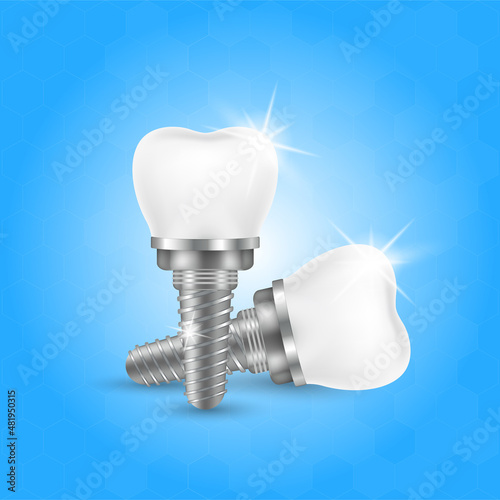 Tooth and teeth implant for stomatology set. Implant structure models. Screw denture orthodontic implantation. stomatology clinic concept. Realistic isolated 3D vector ​illustration.