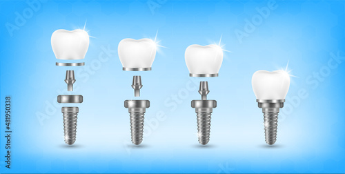 Tooth and teeth implant for stomatology set. Implant structure models. Screw denture orthodontic implantation. stomatology clinic concept. Realistic isolated 3D vector ​illustration.