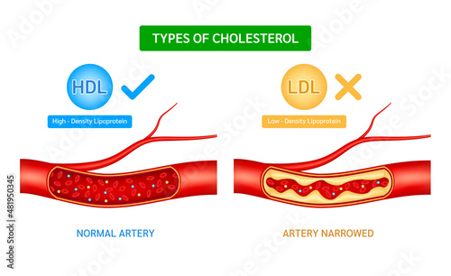 Types of cholesterol comparison with HDL High density lipoprotein and LDL Low Density Lipoprotein. Normal blood flow and Cholesterol artery thrombosis microvascular disease. ​​3D Vector illustration. photo