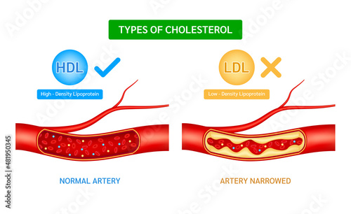 Types of cholesterol comparison with HDL High density lipoprotein and LDL Low Density Lipoprotein. Normal blood flow and Cholesterol artery thrombosis microvascular disease. ​​3D Vector illustration.