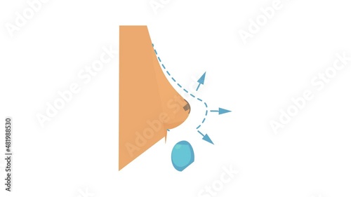 Breast implant surgery icon animation best cartoon object on white background