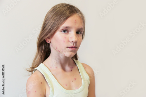 Tableau sur toile Cute little girl with chickenpox at home. Varicella zoster virus.