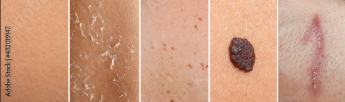 Composition with normal, dry, blemished and scarred skin and skin with a mole