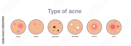 Acne concept. type of acne.papule,nodule,blackhead'whitehead,pustule,cystic.flat vector illustration.