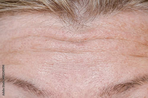 Woman face wrinkle on forehead before rejuvination procedures, injections, treatment, surgery