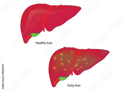 Biological illustration of fatty liver and healthy liver